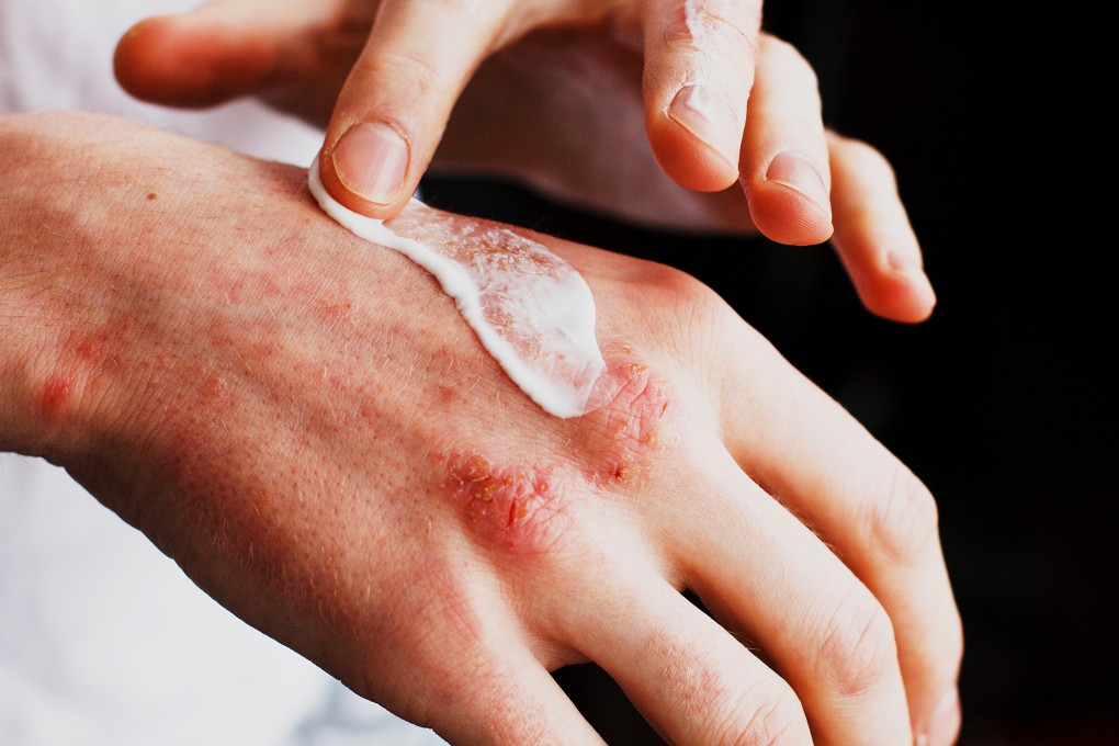 A man applies ointment on dry, itchy patches of skin with eczema. Photo: Shutterstock
