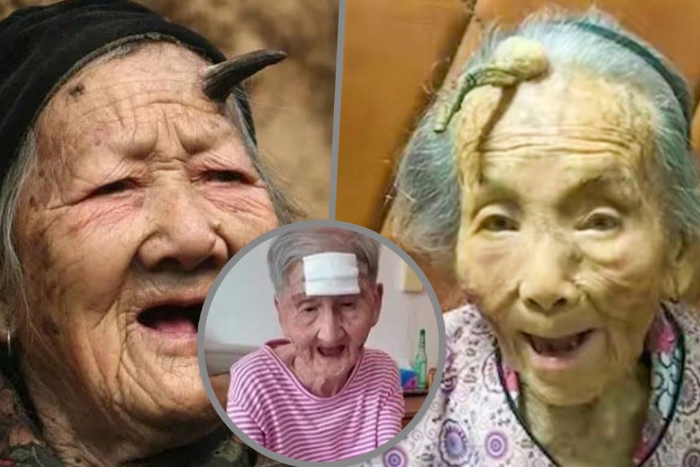 Cutaneous horns, which are horn-like growths, can develop in older adults, especially those aged between 60 and 80. However, Gu (circle photo) took the drastic step of cutting off hers with a pair of scissors. Photo: SCMP composite/QQ.com/people.com.cn/The Paper