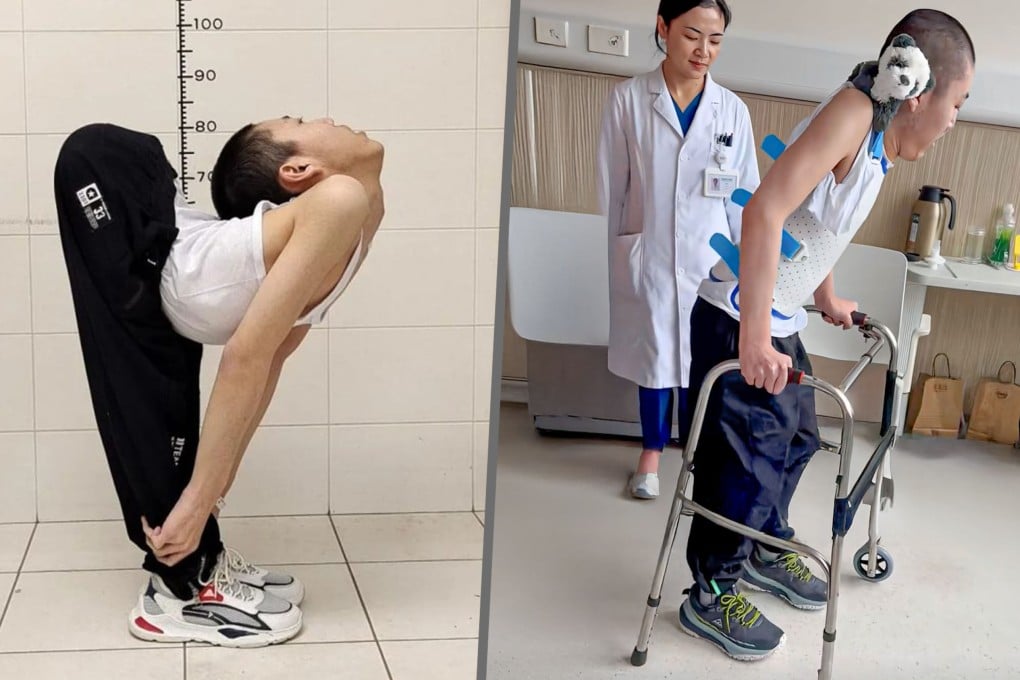 China’s so-called folded boy finally stands upright after four operations to break and reset his body. Photo: SCMP composite/Douyin