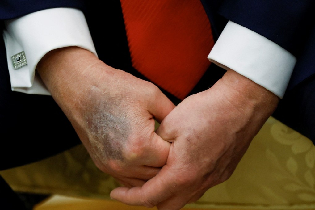 The bruised right hand of US President Donald Trump is visible during a meeting with South Korean President Lee Jae-myung at the White House on August 25. Photo: Reuters