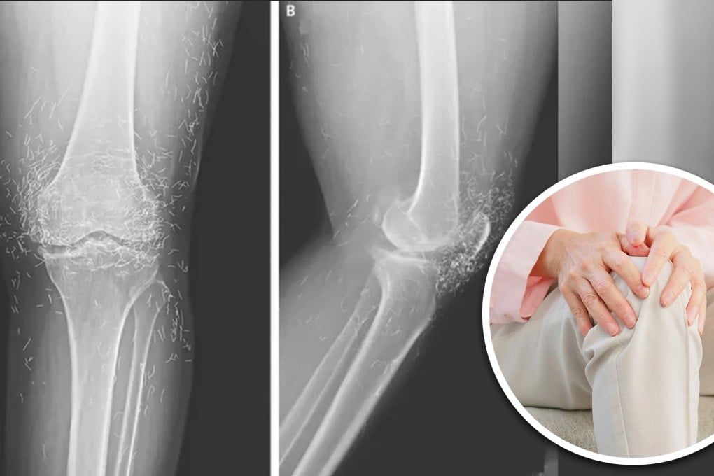 Golden thread acupuncture involves embedding tiny gold wires in acupuncture points to purportedly provide continuous pain relief, which is popular in some Asian regions. Photo: SCMP composite/Shutterstock/The New England Journal of Medicine