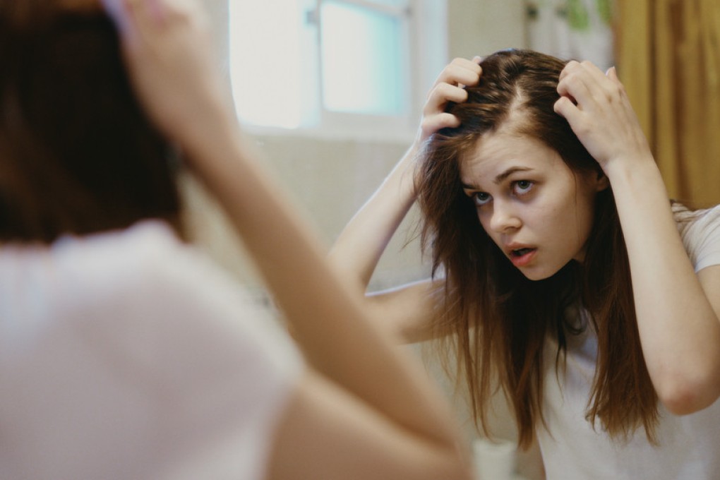 There are many types of hair loss and a variety of causes, with stress, diet and age as key factors. Photo: Shutterstock