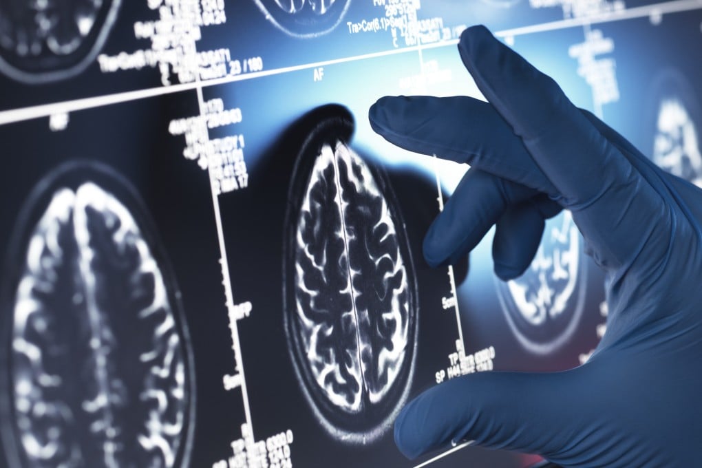 The research team has identified the gene variant TREM2 H157Y as potentially leading to more rapidly deteriorating cases of Alzheimer’s. Photo: Getty Images