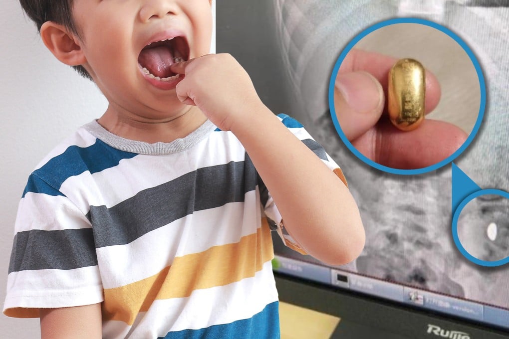 An 11-year-old Chinese boy accidentally swallowed a gold bead worth US$1,400 which had to be retrieved with the help of doctors. Photo: Shutterstock/Baidu