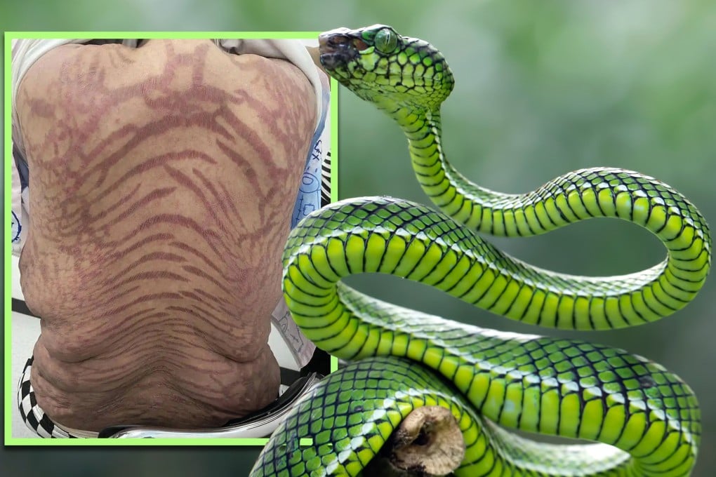 Bahaya Krim Tradisional: Wanita Alami Luka Kulit Parah Setelah 10 Tahun Pakai