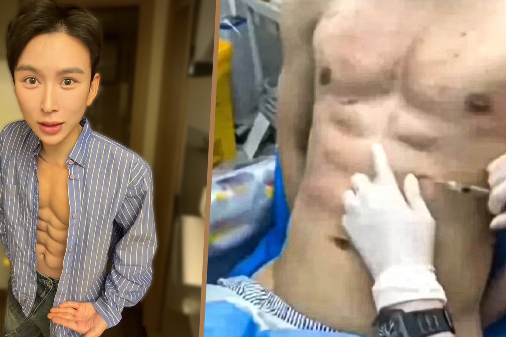 A Chinese man has sparked controversy by spending US$560,000 on acid injections to achieve artificial abs. Photo: Douyin