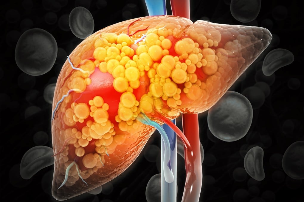 Metabolic dysfunction-associated steatotic liver disease (MASLD), formerly known as non-alcoholic fatty liver disease (NAFLD), is a common liver disease driven by metabolic dysfunction. Photo: Shutterstock