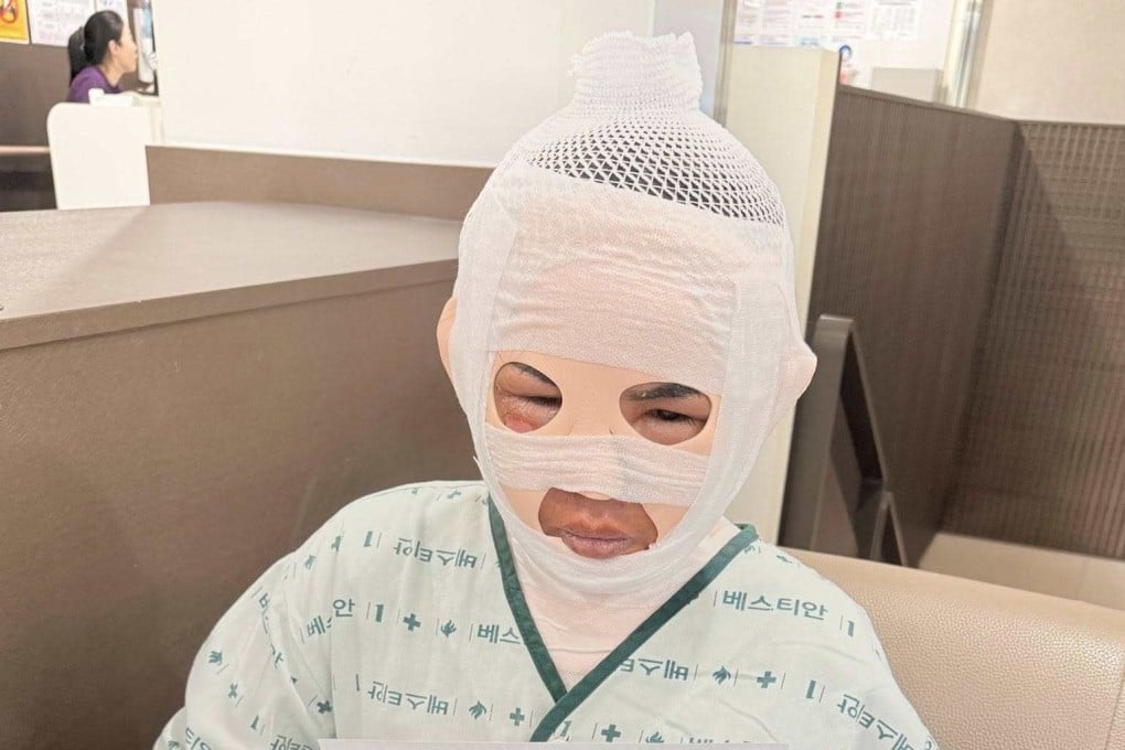 The woman shown with gauze on her face on December 3 suffered second-degree burns. Photo: Nnutt Aaomsin