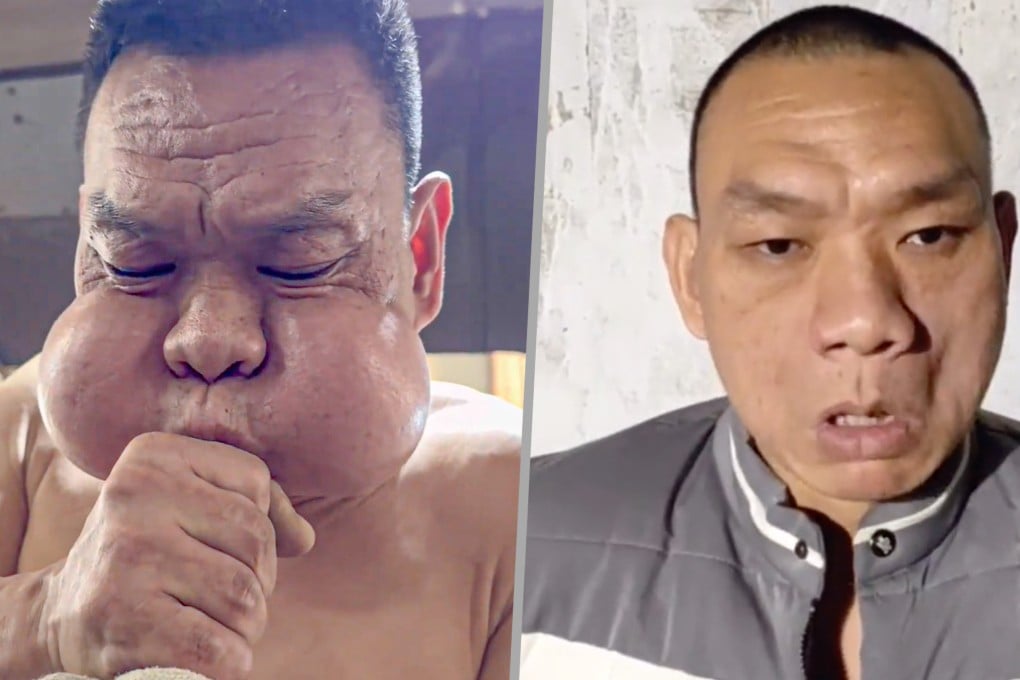 A glassblower in China has become known as the “frog prince” after 30 years of work left his cheeks unusually protruded. Photo: Douyin