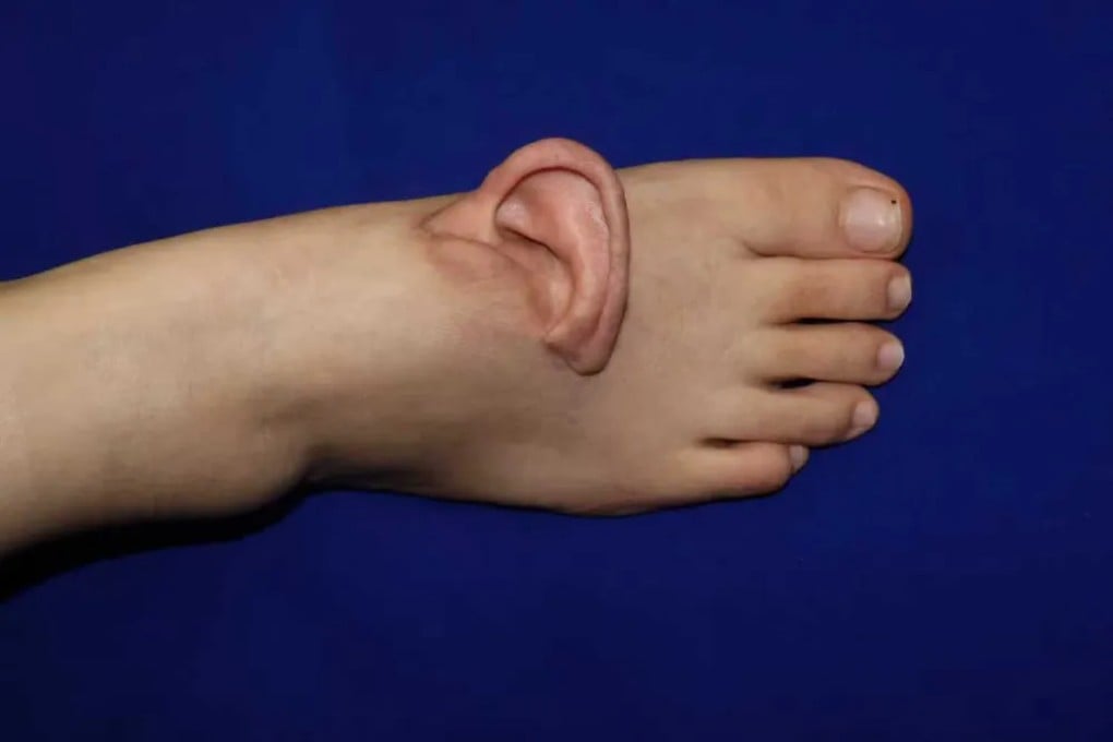 The ear spent months grafted to the patient’s foot. Photo: QQ.com