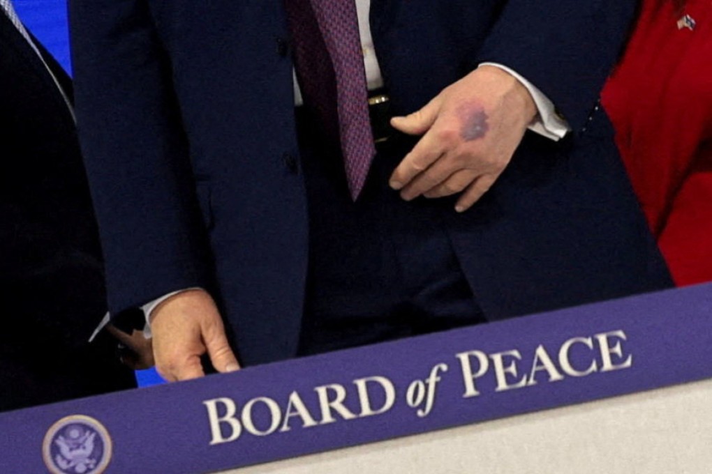 US President Donald Trump’s bruised hand on Thursday. Photo: Reuters