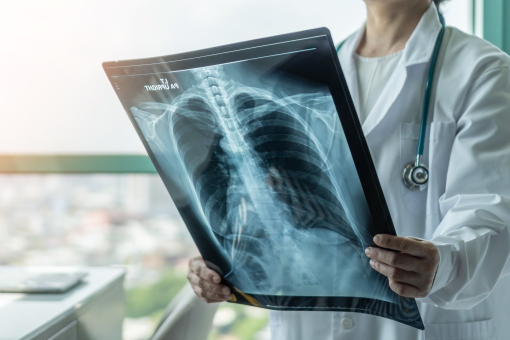 A doctor looking at an X-ray for signs of lung disease, such as  tuberculosis. Photo: Shutterstock