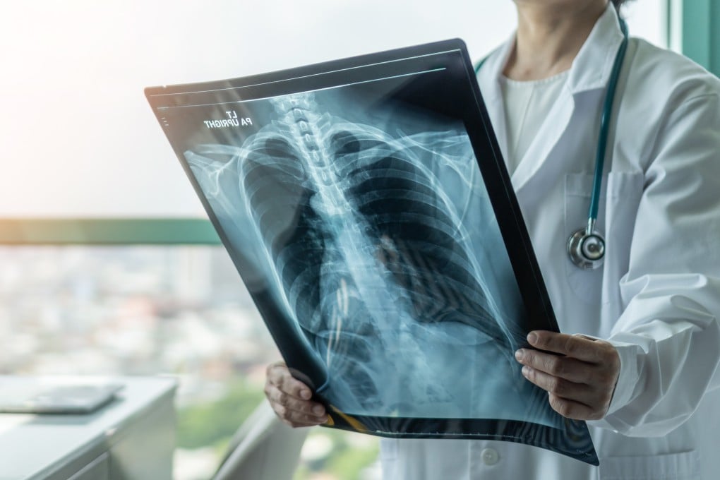 A doctor looking at an X-ray for signs of lung disease, such as tuberculosis. Photo: Shutterstock