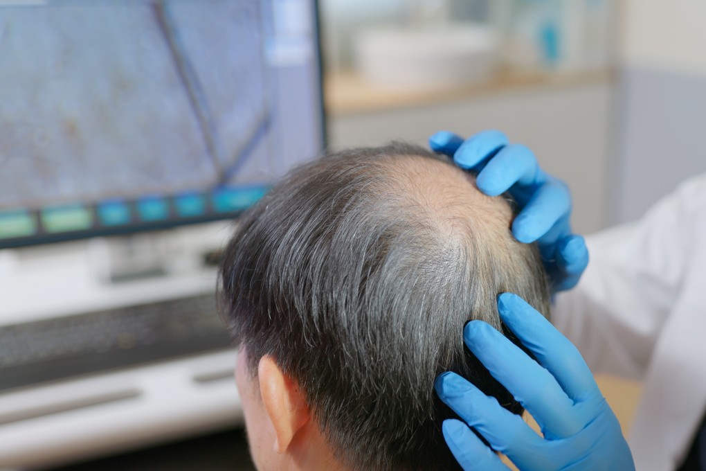 Complaints related to hair transplant, hair growth, and hair and scalp care services reached 33, 19 and 13, respectively, between 2023 and 2025. Photo: Shutterstock