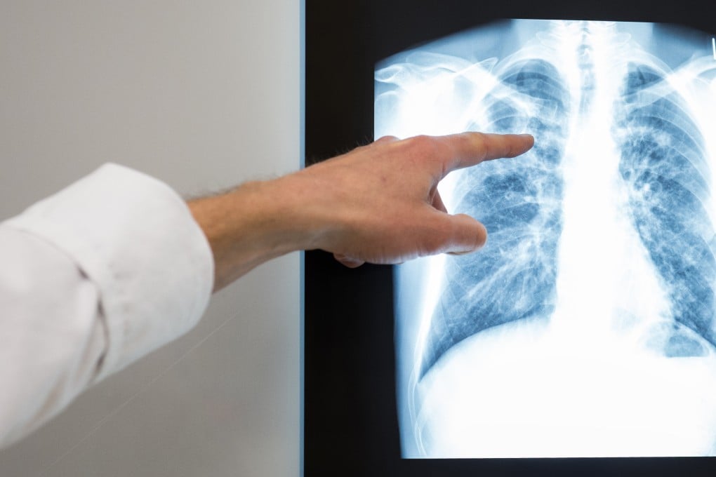 A doctor points to a lung X-ray in a hospital. A total of 596 new tuberculosis cases were reported across Malaysia over a week, the health ministry says on Saturday. Photo: dpa