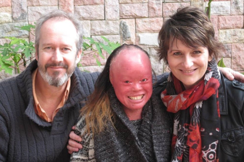 Rog and Tina Thomas pose for a picture with their daughter, Mui, whom they adopted 30 years ago, in a Facebook post from 2015. Mui was born with Harlequin ichthyosis, a rare and often fatal genetic disorder. Rog and Tina now share their story in their new book, An Unexpected Adoption: The Girl Behind The Face.