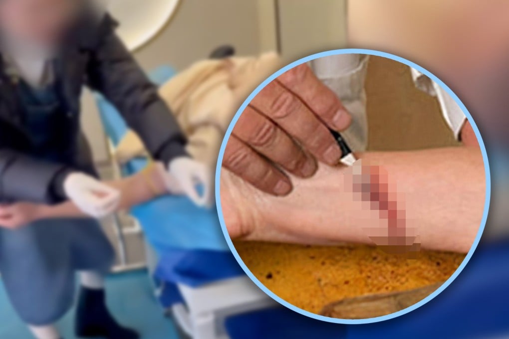 The Chinese authorities have cracked down on self-proclaimed doctors who have been performing “bloodletting therapy”, claiming it can remove evil energy. Photo: SCMP composite/Weibo/Zhihu