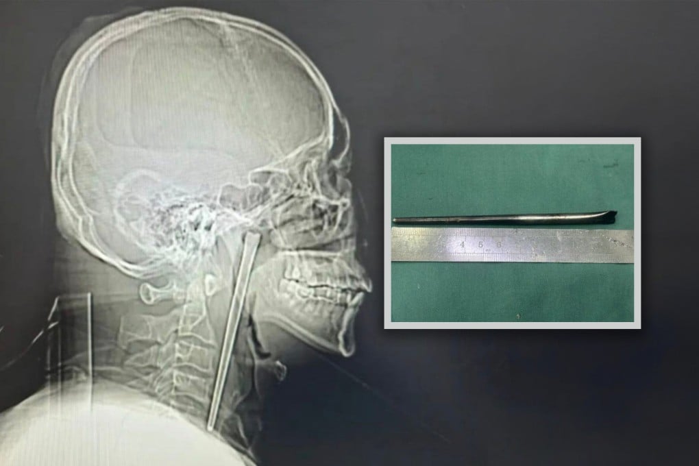 Pria di China Jalani Operasi Angkat Sumpit di Tenggorokan Setelah 8 Tahun