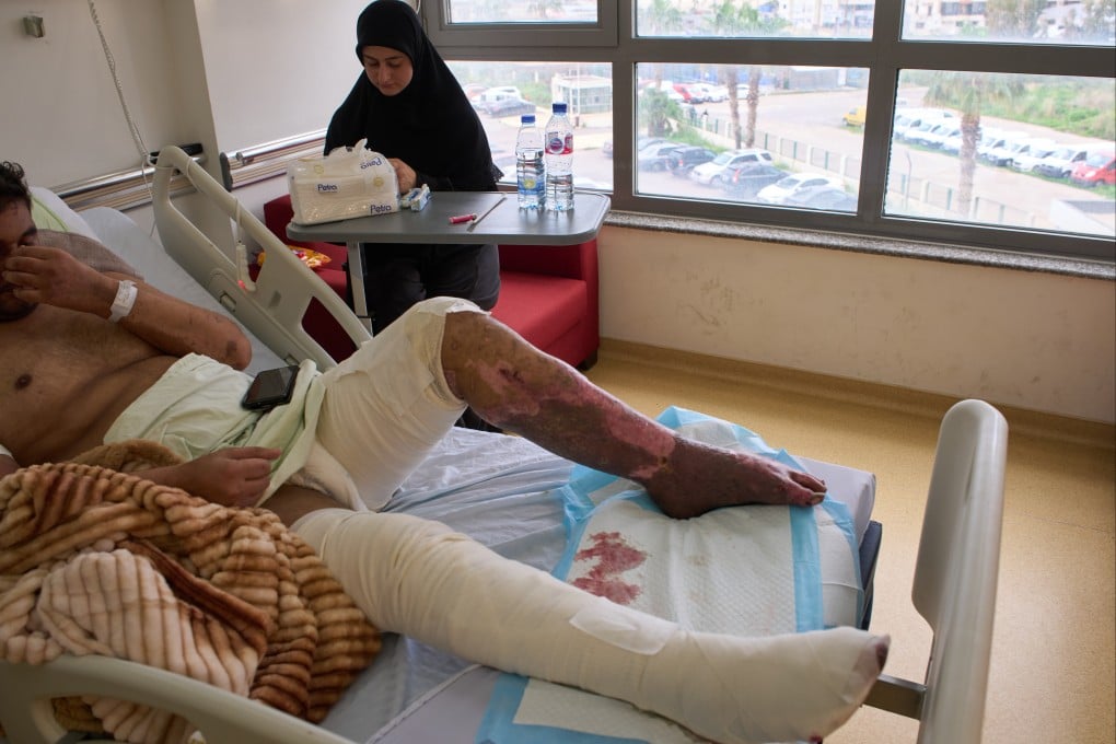 A man with burn wounds from an Israeli airstrike on southern Lebanon in a hospital bed on Thursday. Photo: AP