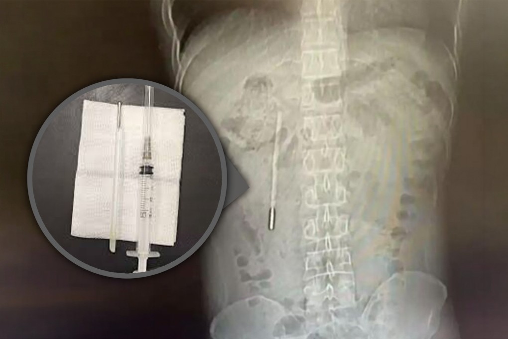 A 32-year-old Chinese man sought medical attention for stomach pain and was astonished to learn that a thermometer he had swallowed when he was 12 years old had remained inside him for 20 years. Photo: SCMP composite/Weibo