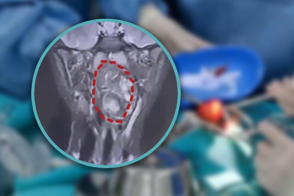 A six-year-old Chinese boy discovered a lump in his throat that was initially thought to be his undeveloped twin sibling. Photo: SCMP composite/QQ.com