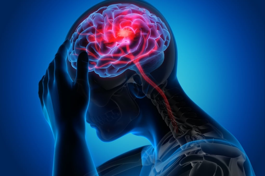 A South Korean team has published a new study that could potentially lead to the treatment of stroke and other neurodegenerative diseases. Photo: Shutterstock