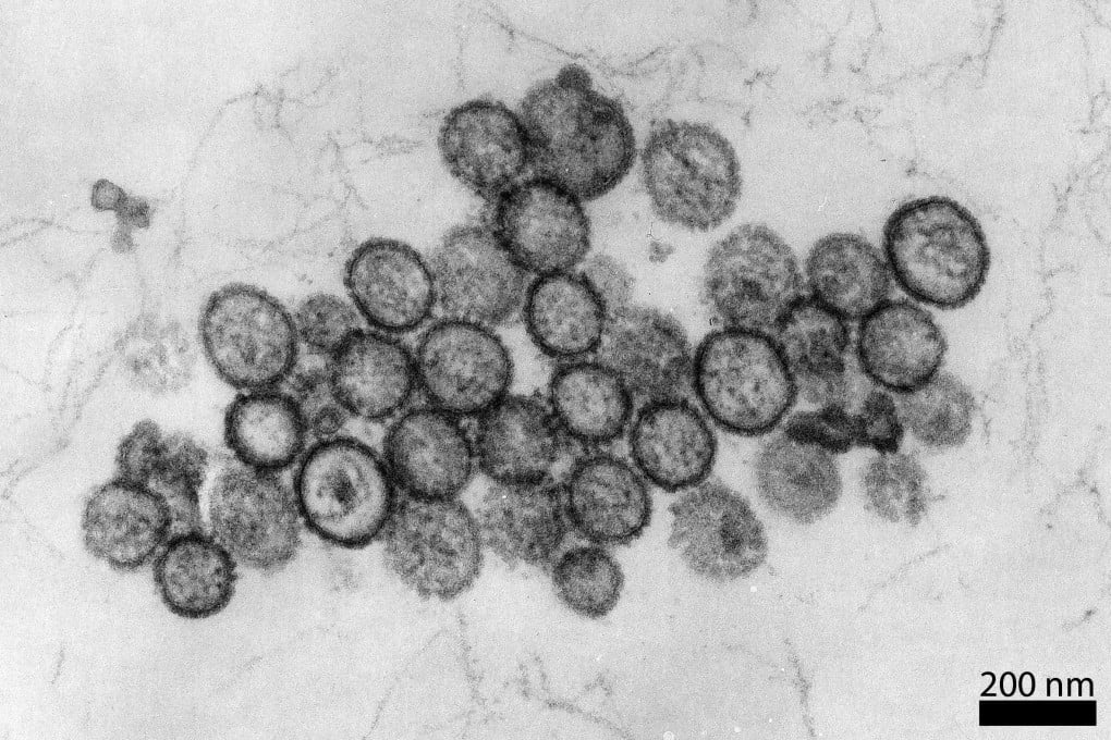 Early signs of the virus include flu-like symptoms such as fever, headaches and muscle pain. Photo: Hans R. Gelderblom/RKI/dpa