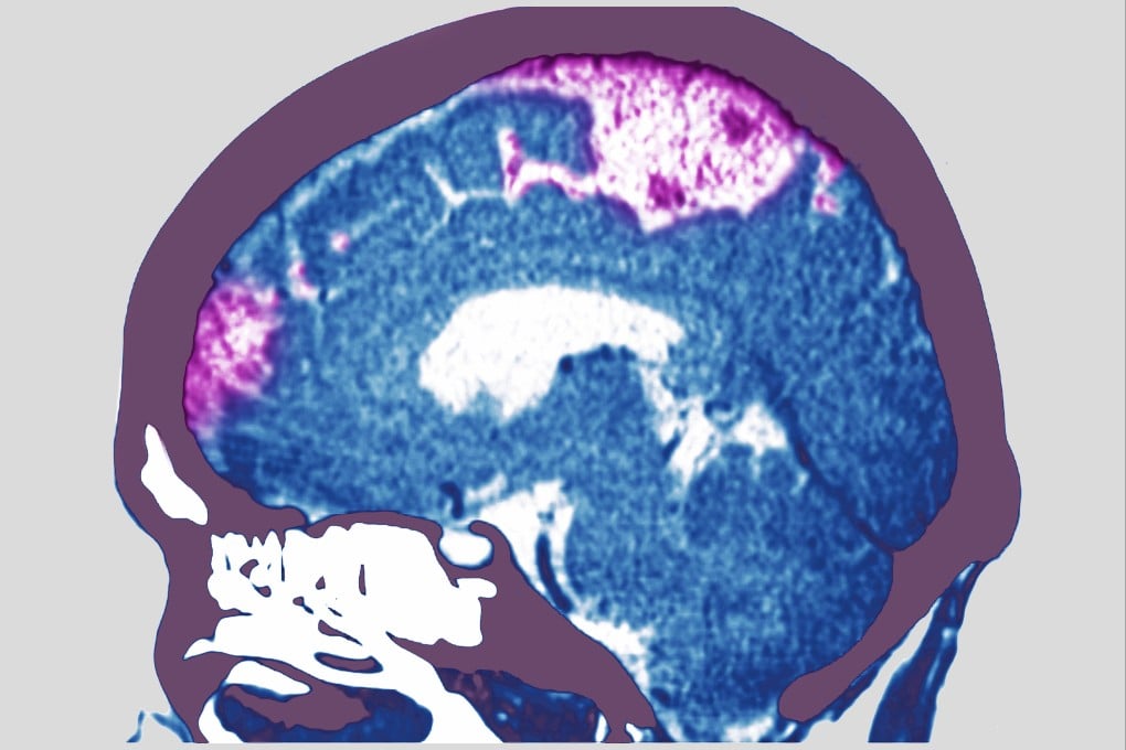 The research is the world’s first phase two clinical trial on the use of GLP-1 for stroke treatment. Photo: Getty Images