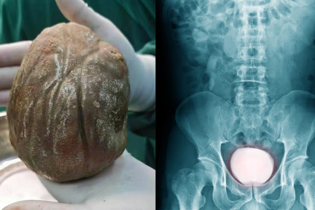 A Chinese man suffering from frequent pain during urination for three years finally discovered a massive 1.3kg bladder stone, shown above alongside a reference X-ray illustrating the condition. Photo: Handout/Shutterstock