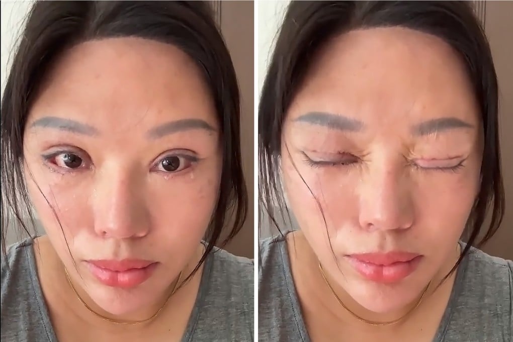A woman from China had double eyelid surgery five years ago which led to severe complications and a bitter legal battle. Photo: Weibo