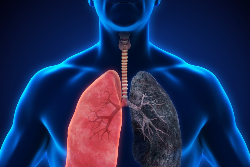 Illustration of a healthy lung and a smoker's lung. Photo: Shutterstock