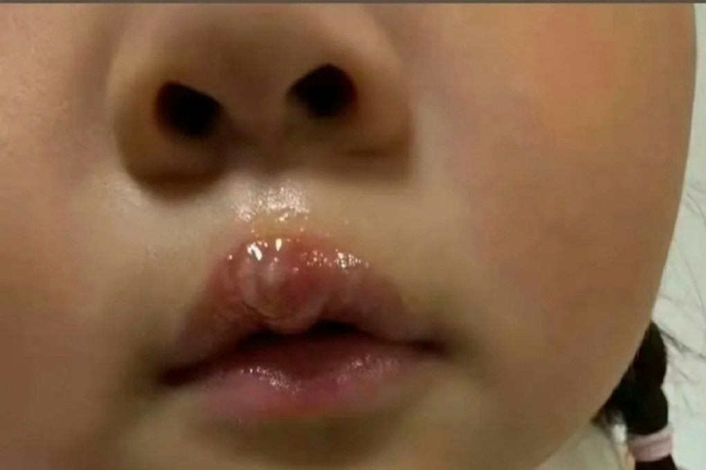 A teacher in China is under investigation after she used a glue gun to scald a little girl. Photo: Weibo