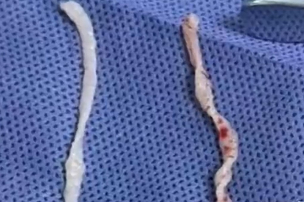 After enduring a painful, swollen lump in her arm for an entire year, a Chinese woman finally got relief when doctors surgically removed two live, 10-cm-long worms. Photo: Weibo