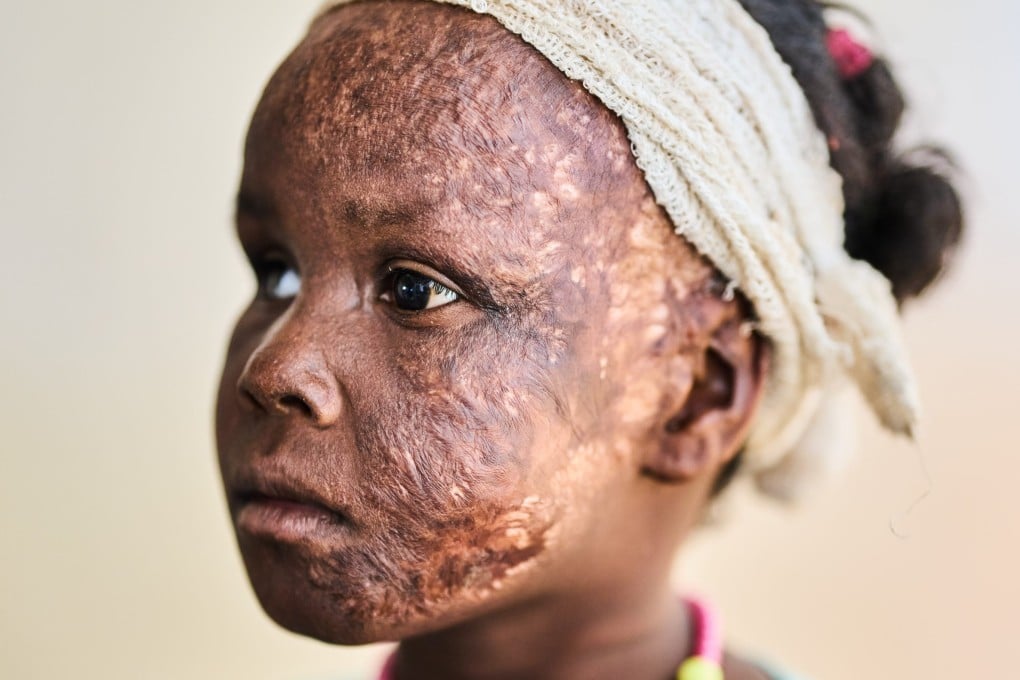 Zeinab Mujhed, aged eight, who was injured in a shelling attack, poses for a portrait in a hospital on the outskirts of Khartoum, Sudan, in April. Photo: AP