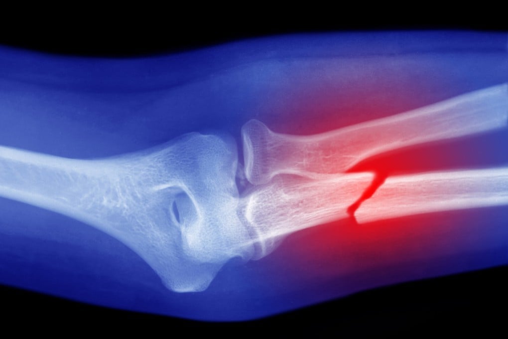 Osteoporosis affects about 30 per cent of women and 8 per cent of men aged 50 and older in Hong Kong. But up to 80 per cent of cases go undiagnosed and untreated. Photo: Getty Images