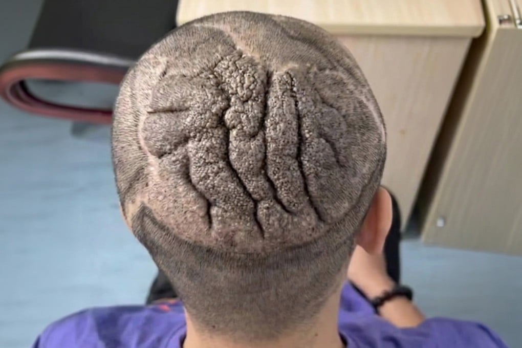 A young man from central China, whose scalp skin looked like the creases of a brain, had been bothered by his appearance for years before finding a solution. Photo: Douyin