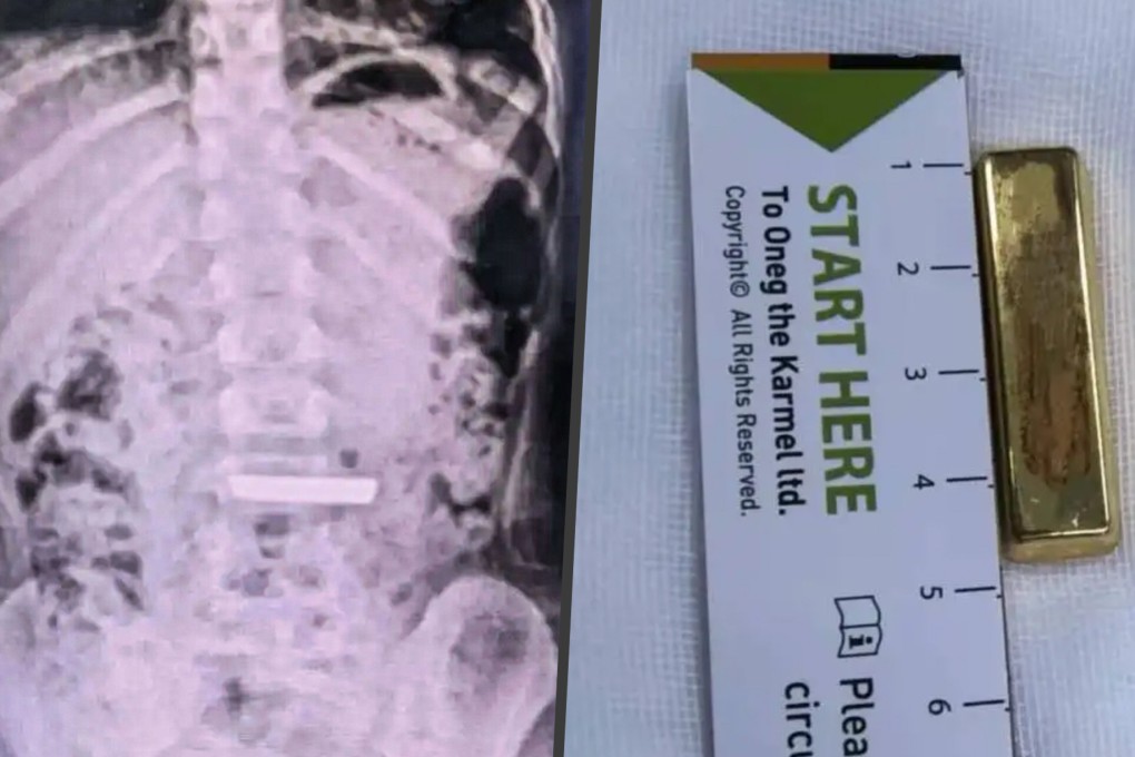 Doctors in China successfully removed a 50g gold bar from a five-year-old child, just hours after she accidentally swallowed it. Photo: SCMP composite/QQ.com