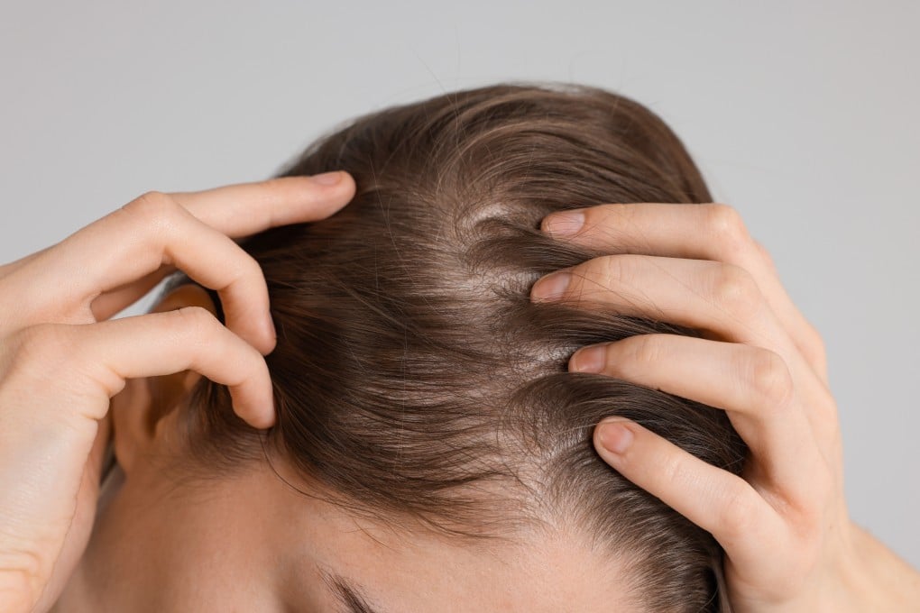Alopecia areata is an autoimmune disease, where the body’s own immune system mistakenly attacks hair follicles. Photo: Shutterstock