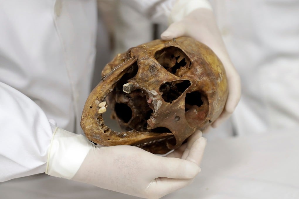 Forensic doctor Daniel Munoz shows the skull of Nazi war criminal Josef Mengele at the school of medicine of Sao Paulo University in Brazil in December 2016. Photo: AP