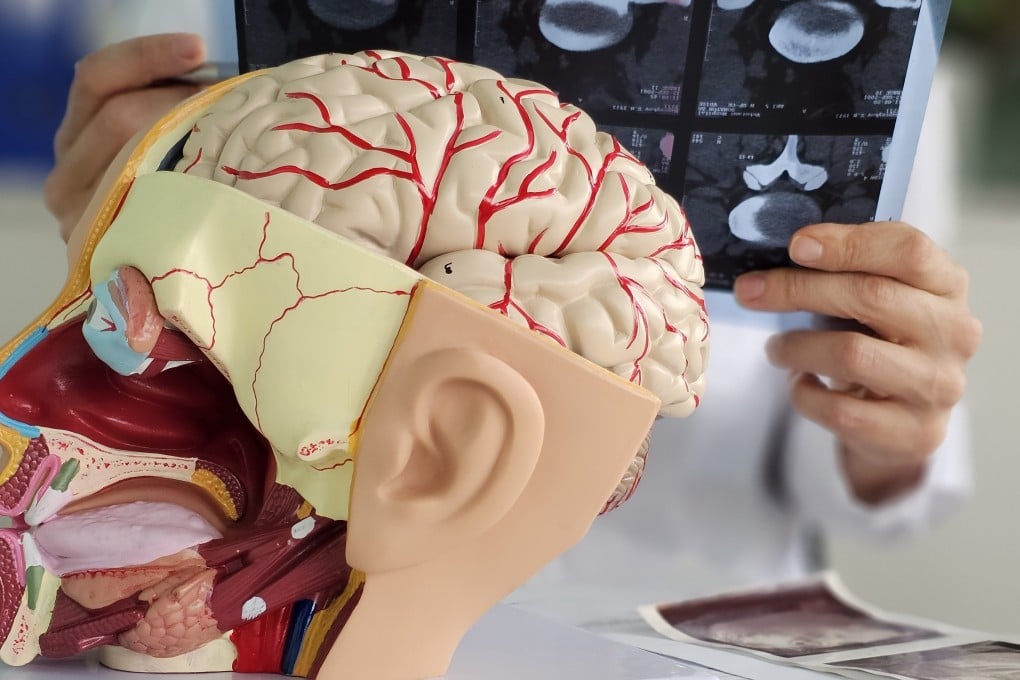 Focused ultrasound is being studied as a non-invasive way to target brain tumours including glioblastoma, an aggressive form of the disease. Photo: Shutterstock