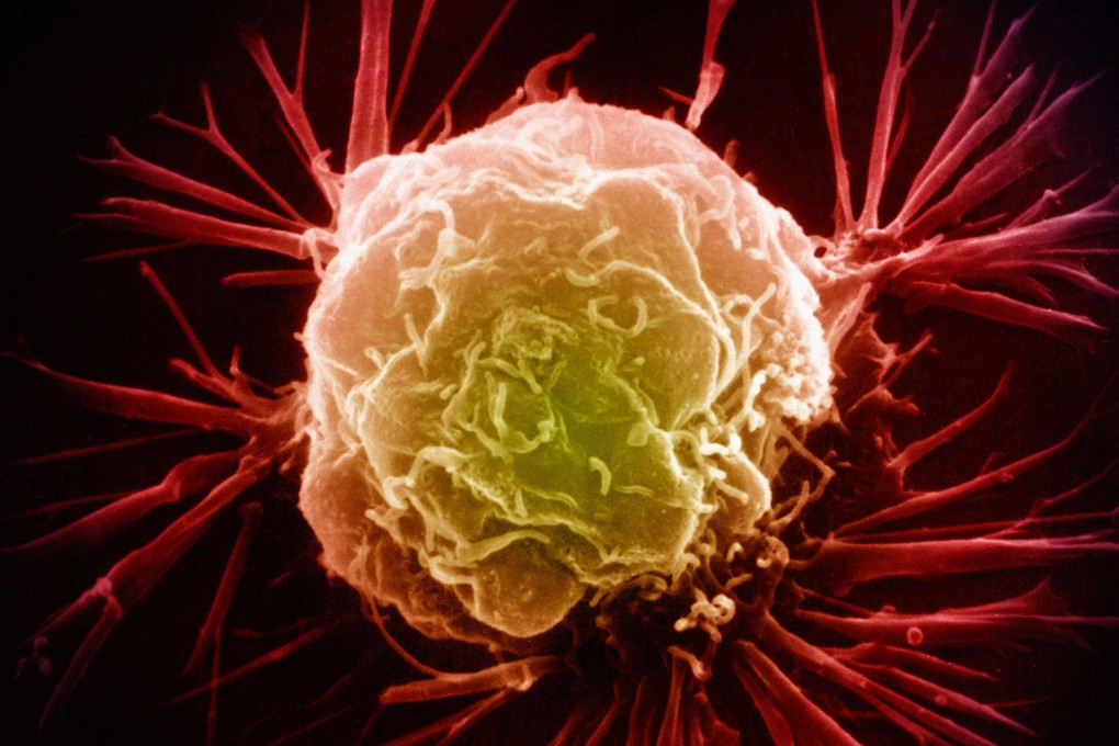 A colourised scanning electron micrograph of a breast cancer cell. Stock photo: Alamy