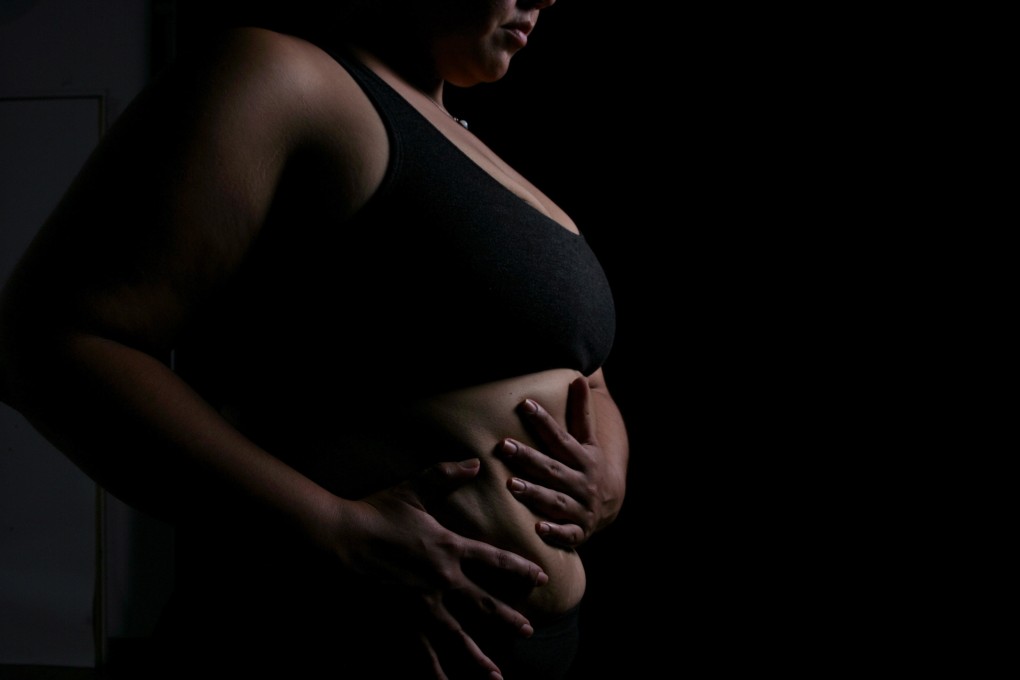 The world needs to stop fat shaming and discriminating against people with obesity, a nutritionist argues. Photo: Alamy