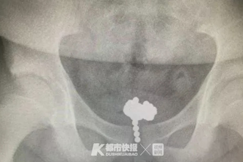 The boy admitted inserting the balls when X-rays showed a shadow in his bladder. Photo: Guancha
