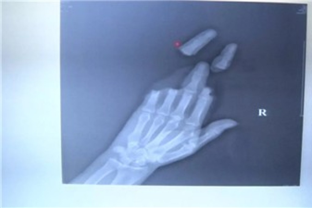 One of the men had three fingers cut off and a fourth partially severed. Photo: Nantong Orthopaedics Hospital