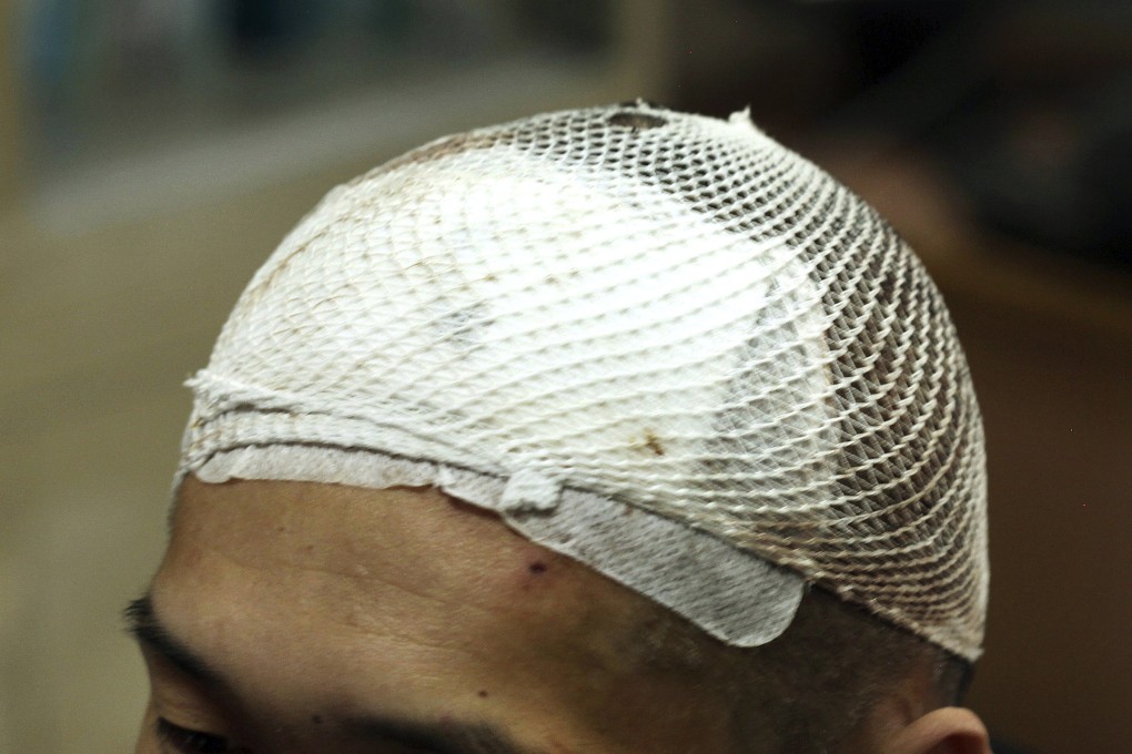 A white mesh covers the head of Yan after he had a deep brain stimulation device implanted as part of a clinical trial at Ruijin Hospital in Shanghai. Photo: AP