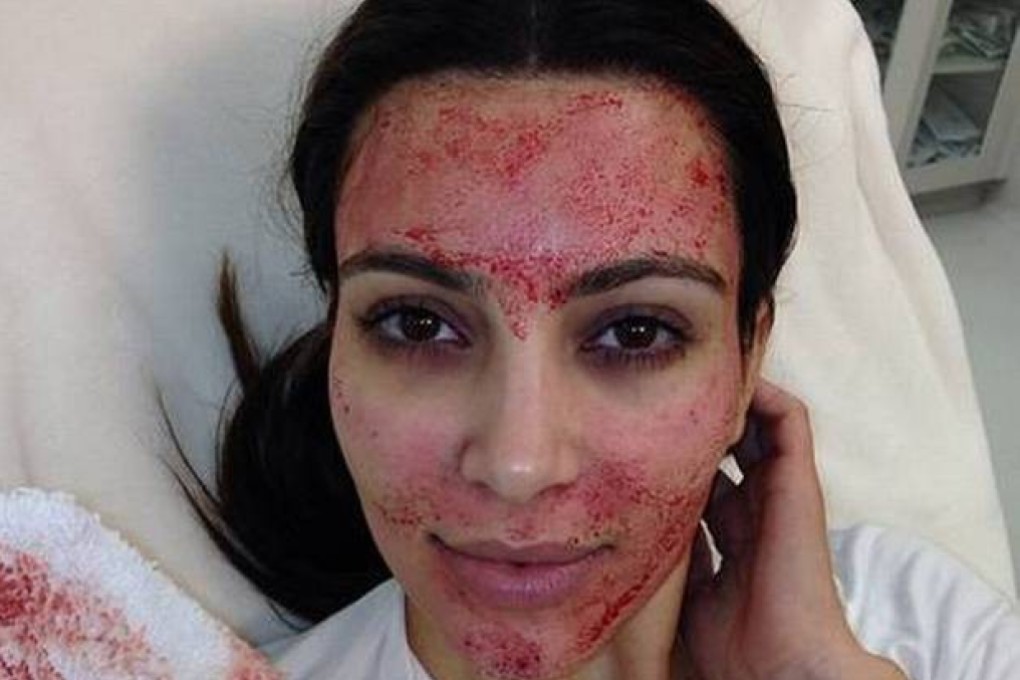 Kim Kardashian West is a fan of vampire facials – but not everyone is.