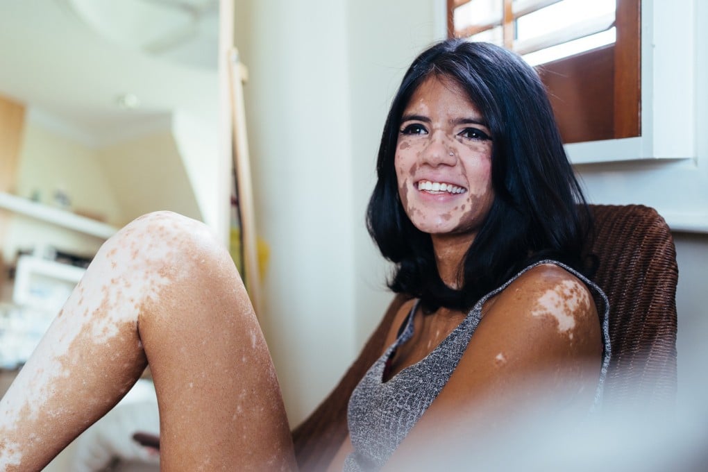 Malaysian model Sonya Danita Charles has vitiligo, a skin condition where uneven pigmentation arises from a lack of melanin. Photo: Melissa Toh