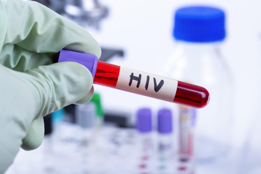 A blood sample for an HIV test. There have been 9,861 HIV infections in Hong Kong since 1984.