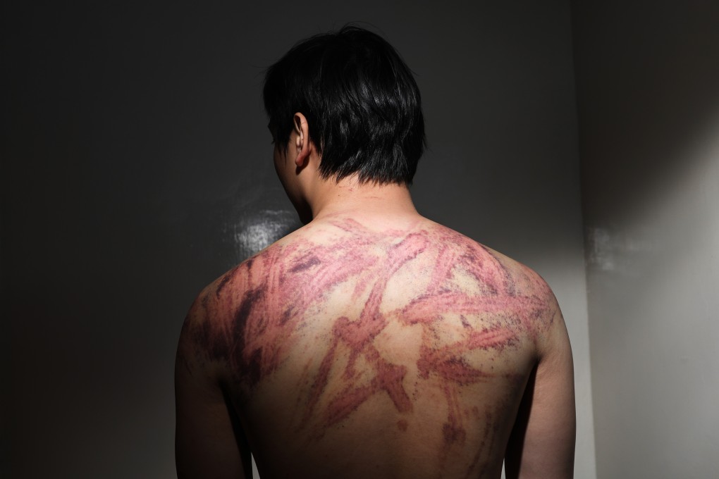 Calvin So shows the marks on his back caused by a brutal attack near Yuen Long MTR station on Sunday night. Photo: Sam Tsang