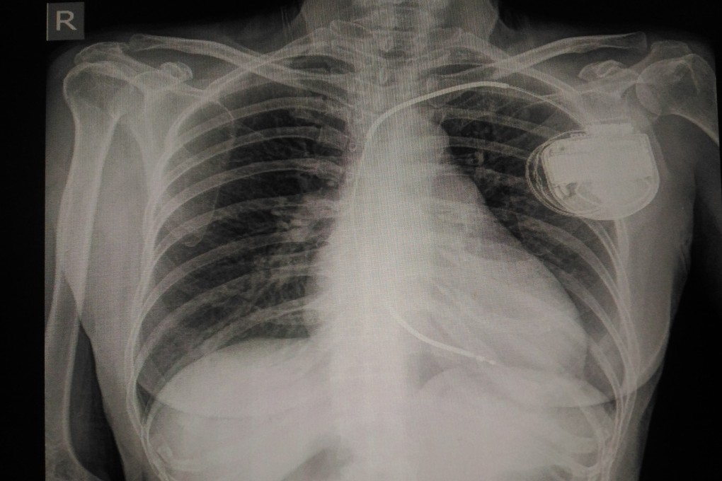 Hospital staff in West Germany were implicated in a plot to recycle pacemakers from corpses.